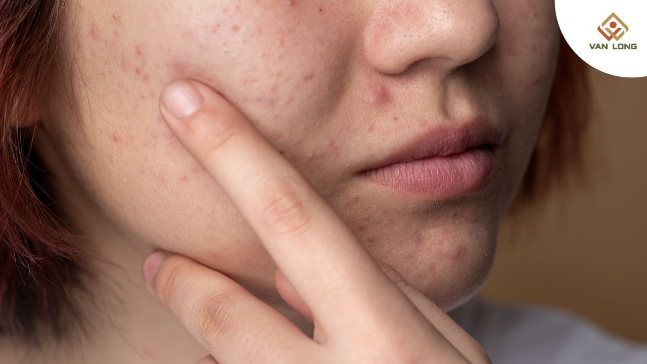 Biểu hiện thường gặp của PCOS và dấu hiệu cảnh báo sớm