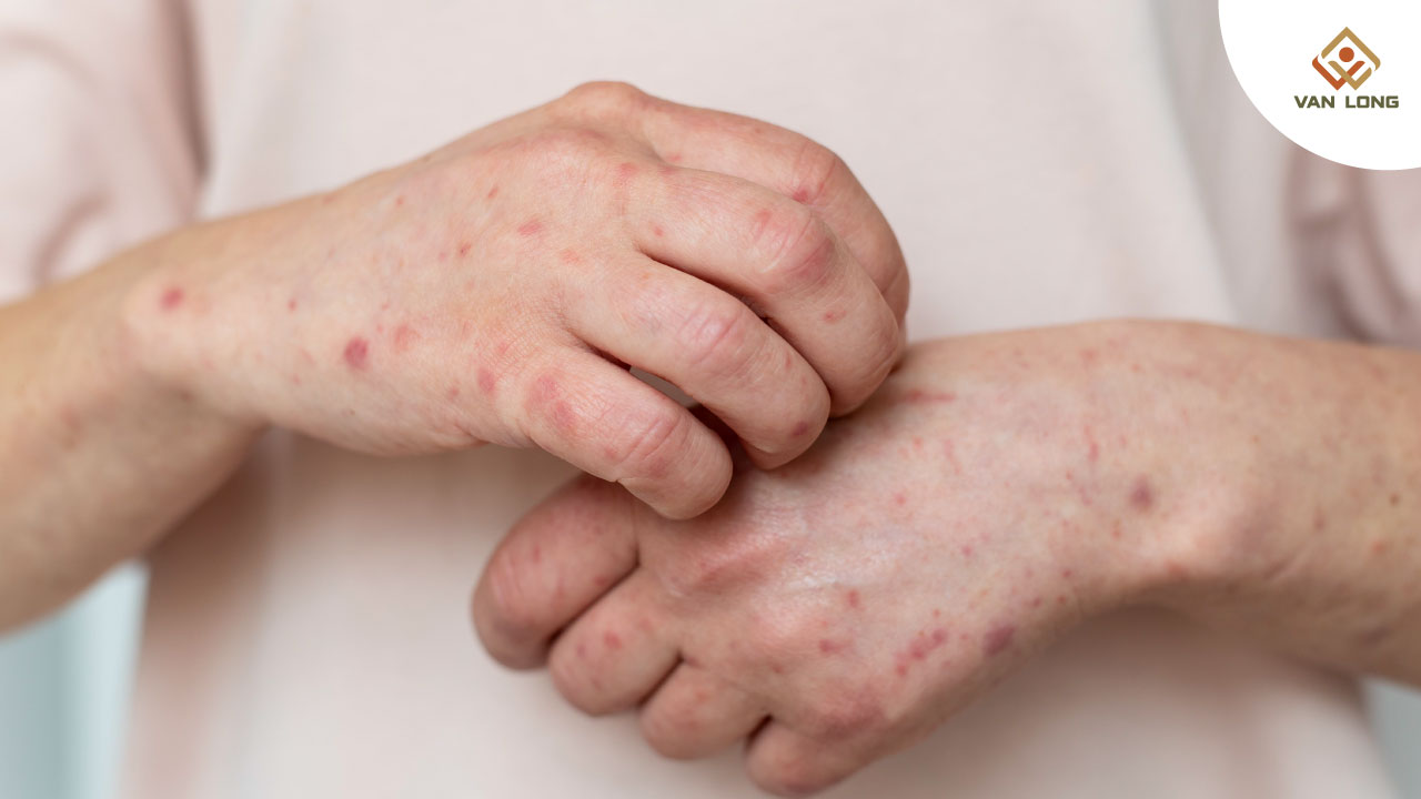 Triệu chứng của bệnh virus Marburg