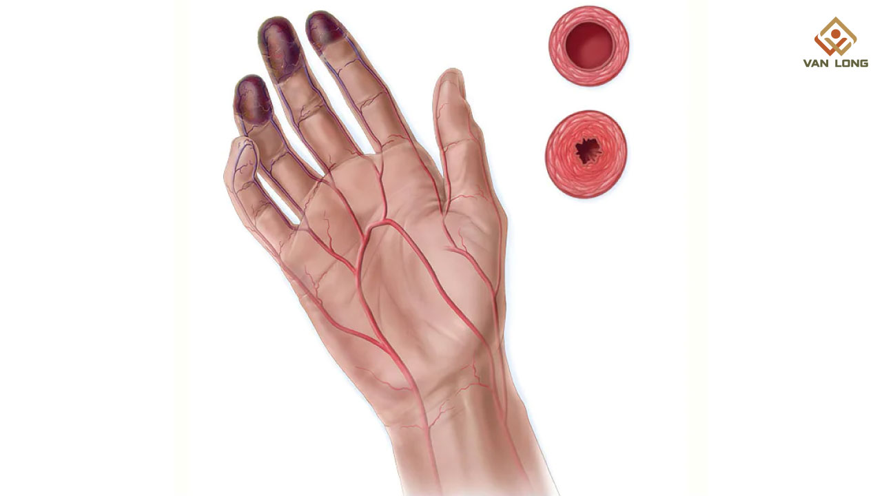 Triệu chứng và biểu hiện lâm sàng