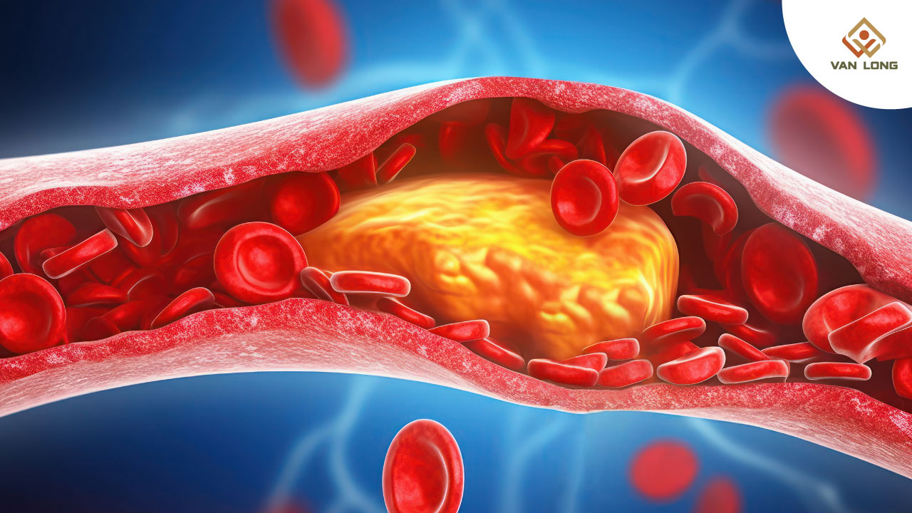 Huyết áp cao tấn công mạch vành như thế nào