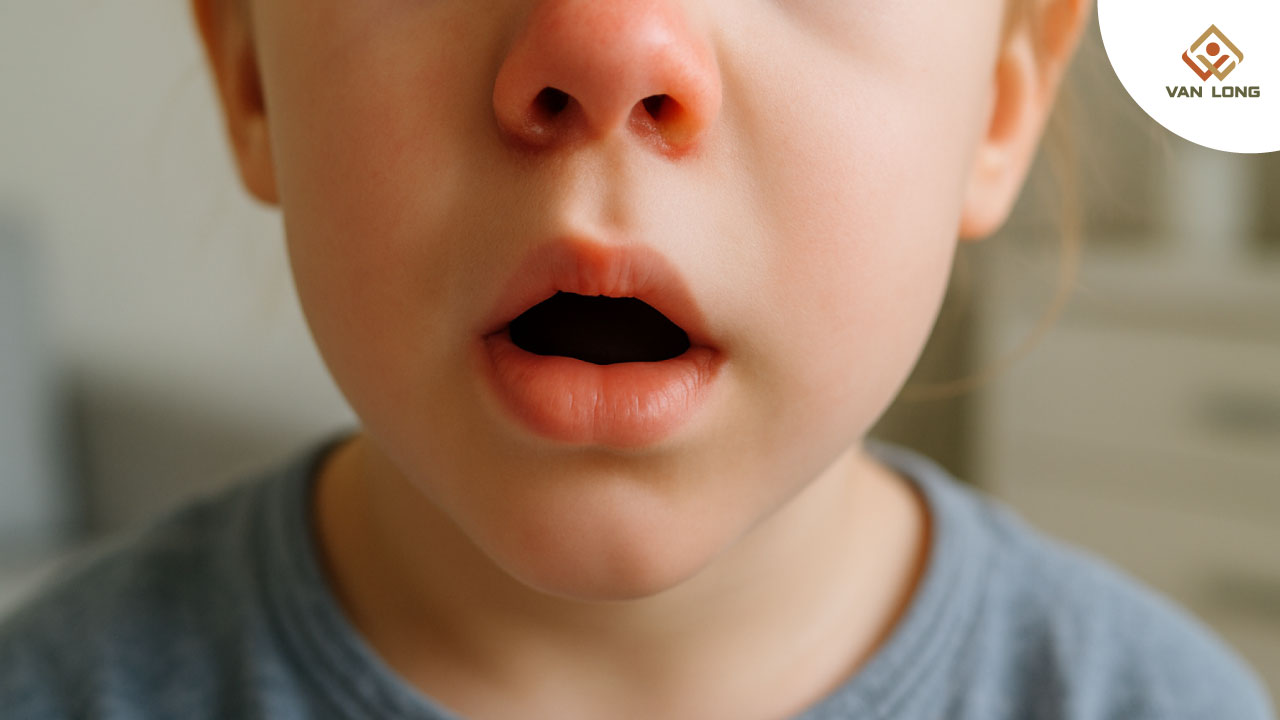  Mũi tắc – mũi khô ở trẻ có nguy hiểm không?