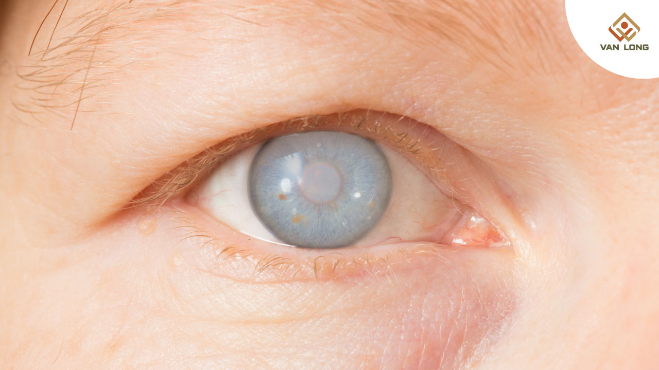 Đục thủy tinh thể do đường huyết cao – vì sao xuất hiện sớm hơn tuổi?